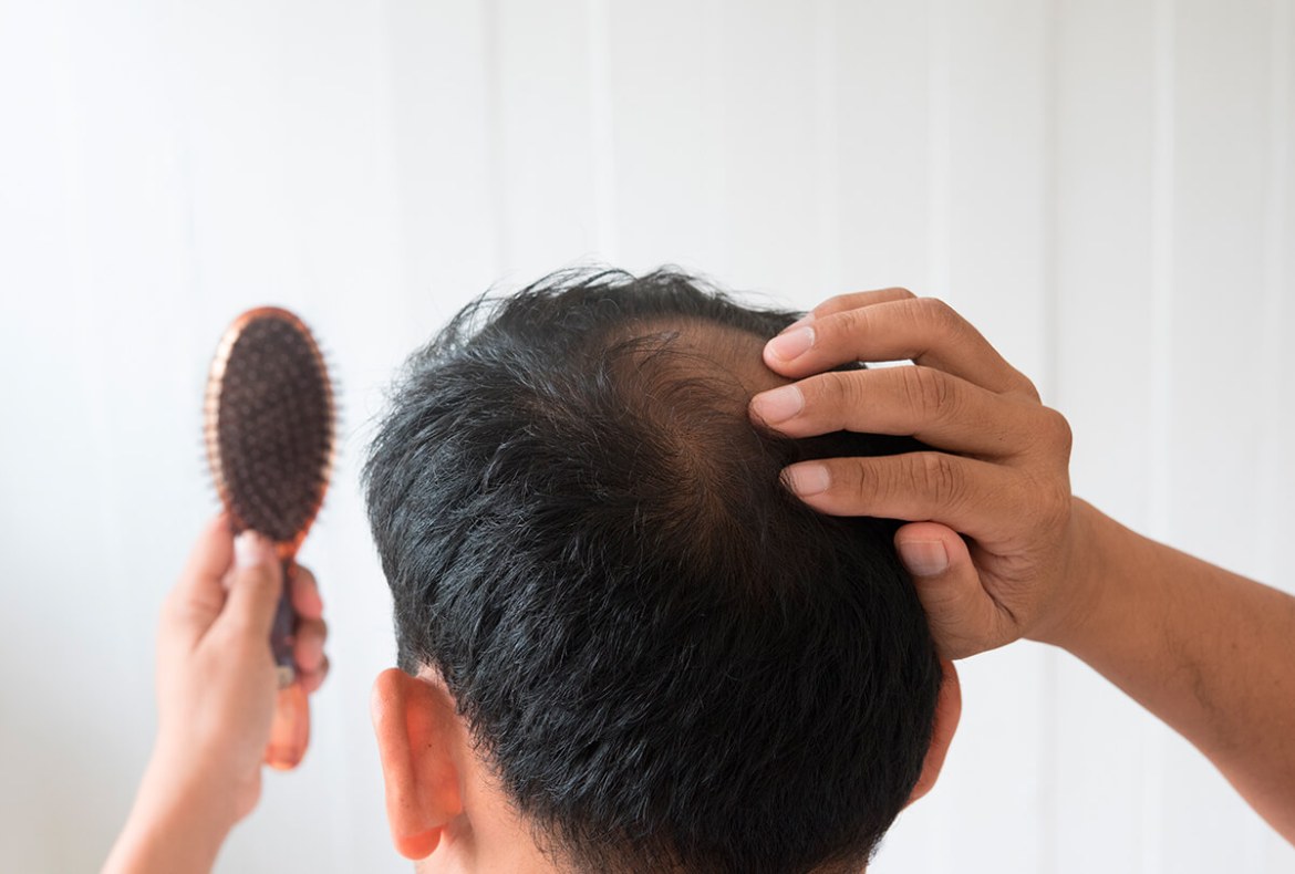 falhas no cabelo masculino